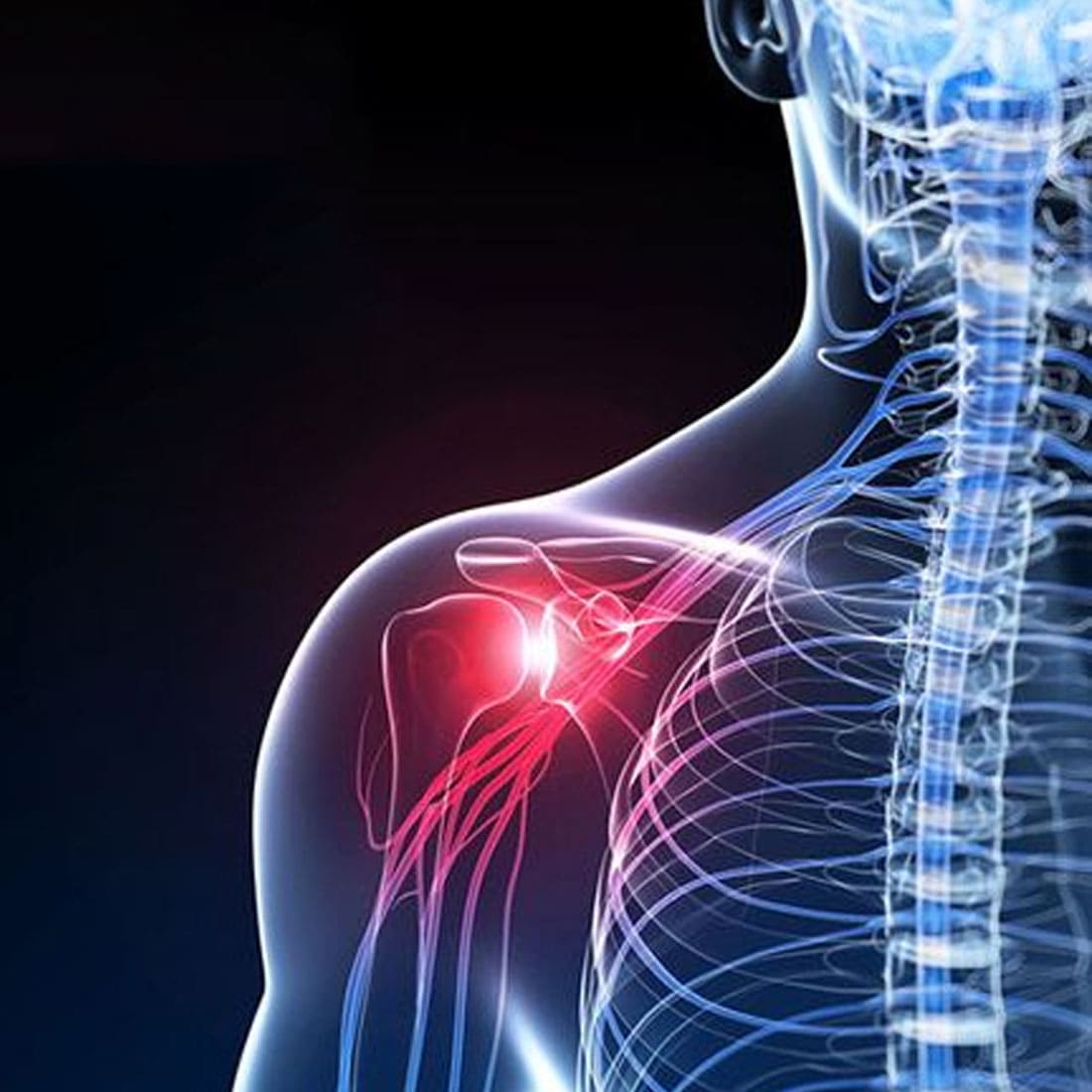 frozen-shoulder