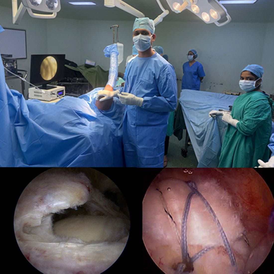 rotator-cuff-tears